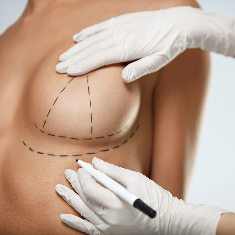 Breast Uplift & Implant